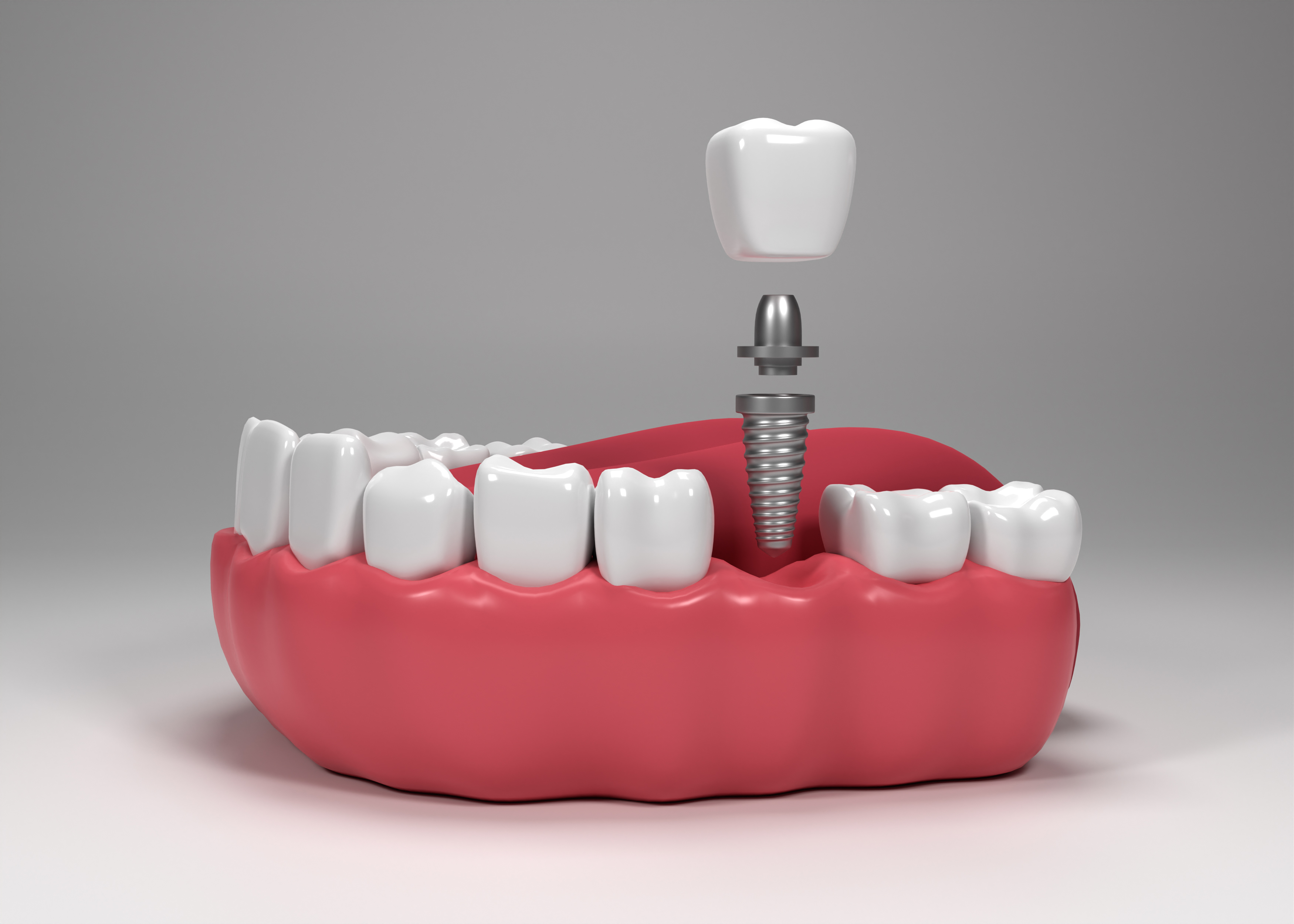 Dental Implants
