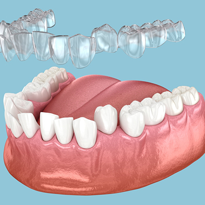 Dental Braces and Invisalign in Nizamabad
