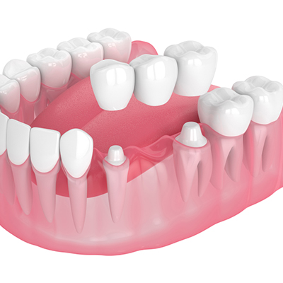 Veneers, Crowns and Bridges in Nizamabad