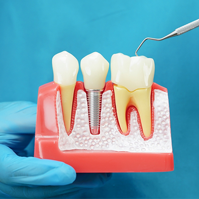 Dental Implants in Nizamabad