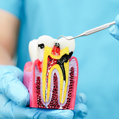Root Canal Treatment in Nizamabad