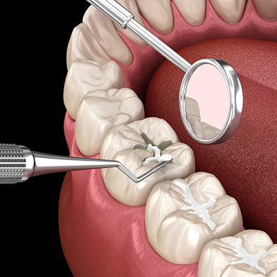 Tooth Fillings in Nizamabad
